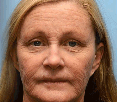🔥Final 3 Hours: 70%OFF🔥 QIAWI™ Botulinum & Vita-A Retinol Shot Wrinkle-Lift Tightening cream✨